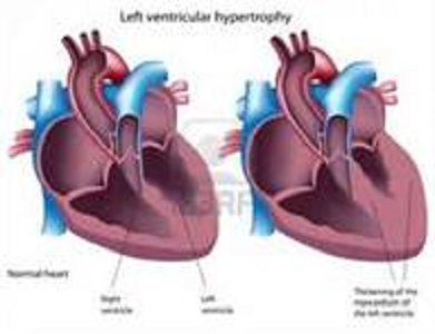 ¿Cúal es la alteración cardíaca más frecuente en pacientes en diálisis?