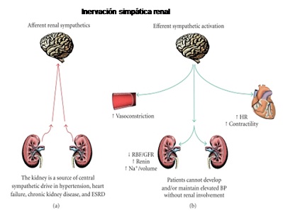Insuficiencia renal crónica: Denervación simpática renal por radiofrecuencia