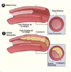 Las calcificaciones vasculaers: ¿Son más frecuentes en pacientes con insuficiencia renal crónica?