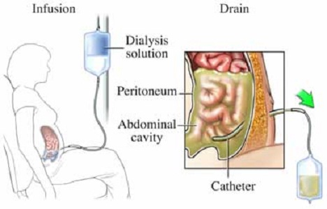 Complicaciones agudas tras implantación de catéter de diálisis peritoneal