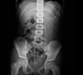 Dolor abdominal en pacientes con enfermedad renal crónica