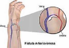 Hematoma de fístula arteriovenosa: una complicación frecuente del acceso vascular