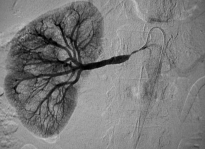 Tratamiento con angioplastia y stent de la estenosis arterial del injerto renal