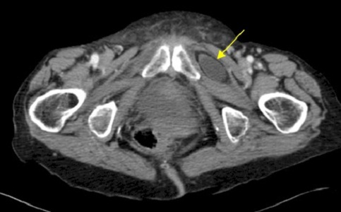 Formación de hernias en pacientes en diálisis peritoneal