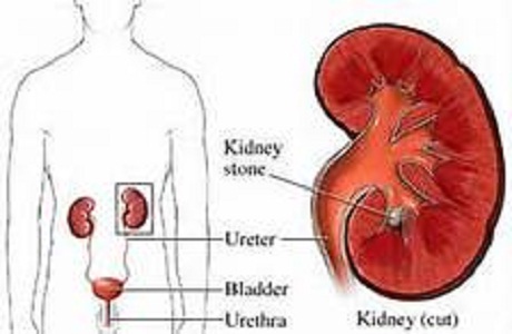 Insuficiencia renal crónica e hiperuricemia