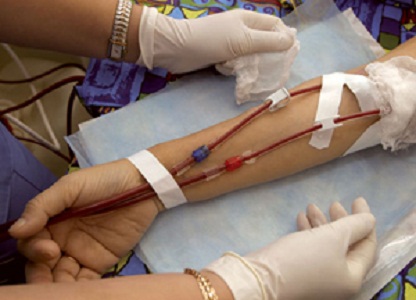 Disfunción de la fístula arteriovenosa de diálisis. ¿Cómo lo podemos detectar?