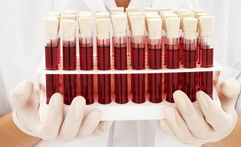 Pacientes en diálisis: ¿Qué beneficios tiene el tratamiento de la anemia?
