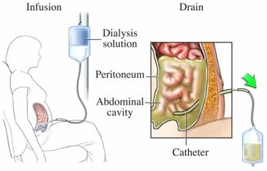 Diálisis peritoneal. ¿Cómo se realiza el transporte de agua y solutos?