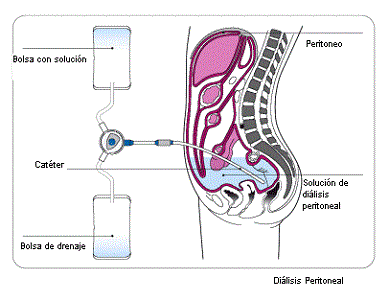 ¿Qué es la albúmina? ¿Es importante en pacientes con diálisis peritoneal?