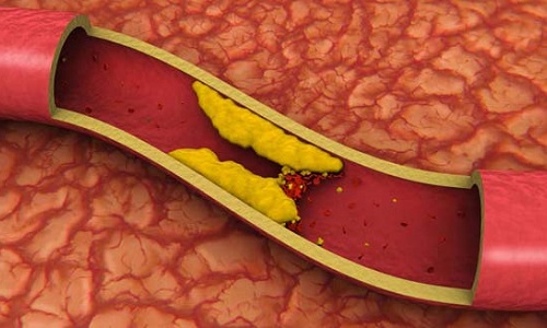 La hipertensión arterial y colesterol: ¿Están relacionados?