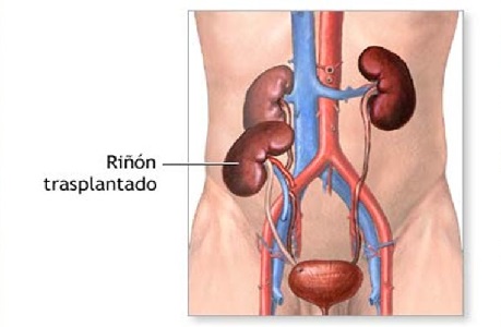 Complicaciones después del Trasplante de riñón