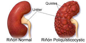 ¿Qué es la poliquistosis renal?