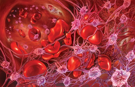 ¿Qué es el síndrome hemolítico urémico?