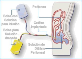 La diálisis peritoneal: ¿Produce pérdida de proteínas?