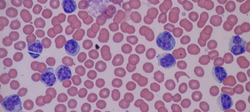 Recuento de linfocitos CD19, marcador de mortalidad de los pacientes en hemodiálisis