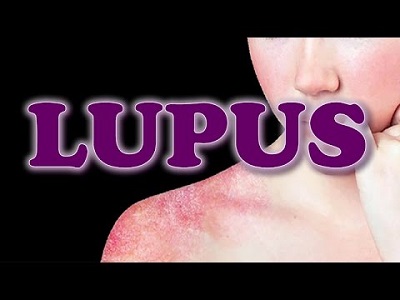 Mejorar el pronóstico del lupus no es tarea fácil