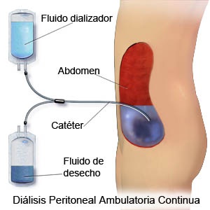 Diálisis peritoneal ambulatoria continua